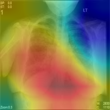 Chest X-ray with heatmap visualization for AI disease detection